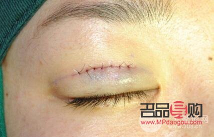 不適合做雙眼皮埋線的人群