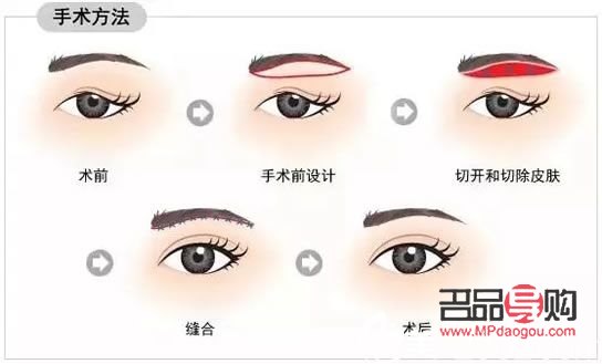 雙眼皮下垂提眉好還是全切好(提眉手術(shù)多大年齡做最好)