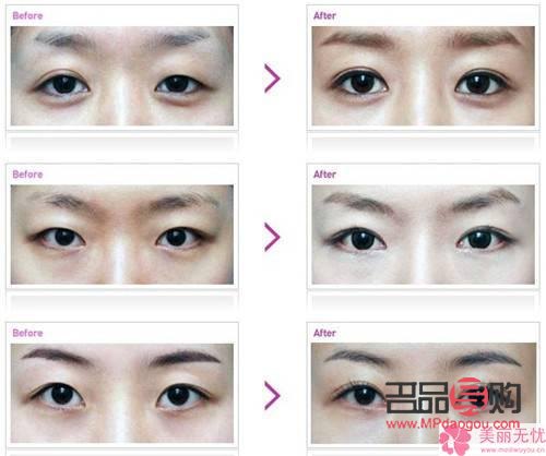 <h3>翹睫術(shù)雙眼皮效果能持續(xù)多久？</h3>