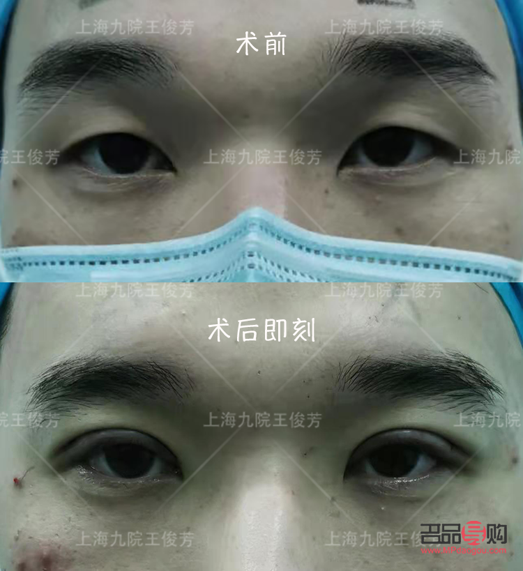 <h3>探索6mm雙眼皮的迷人魅力</h3>