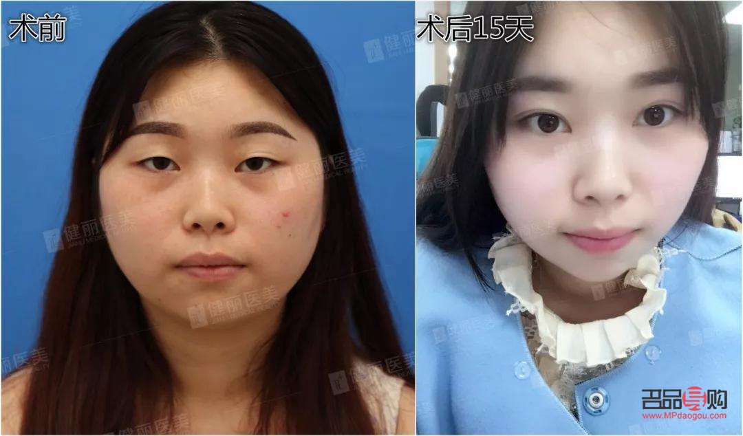 明星雙眼皮做的什么型(明星雙眼皮做的什么型狀)