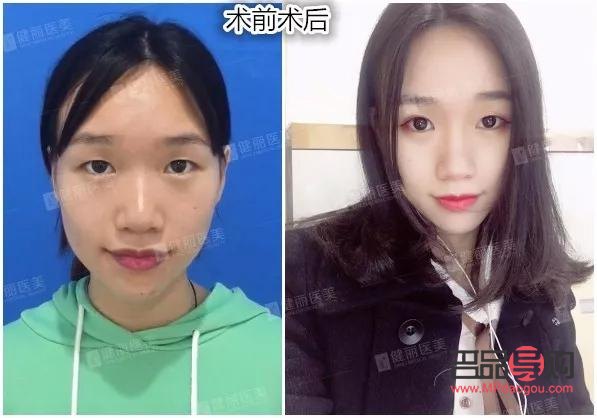 明星雙眼皮做的什么型(明星雙眼皮做的什么型狀)