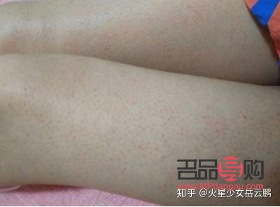 身體雞皮膚怎么護(hù)理(身上的雞皮膚怎么治)