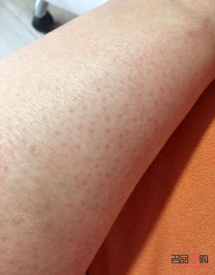 身體雞皮膚怎么護(hù)理(身上的雞皮膚怎么治)