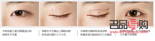 <h3>割雙眼皮大小眼：手術(shù)風(fēng)險與美學(xué)考量</h3>
