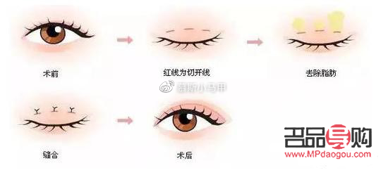 現(xiàn)在流行什么雙眼皮技術(shù)(現(xiàn)在流行什么雙眼皮技術(shù)呢)