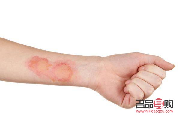 身體燙傷怎么護(hù)理好(身上燙傷)