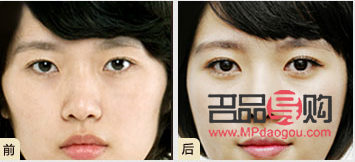 甲亢眼睛突出做手術(shù)要多少費(fèi)用(甲亢眼睛突出做手術(shù)要多少費(fèi)用呢)