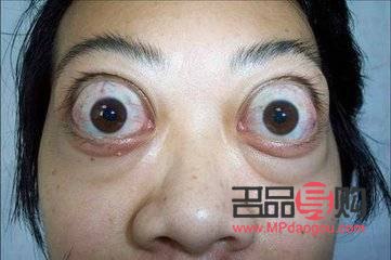 甲亢眼睛突出做手術(shù)要多少費(fèi)用(甲亢眼睛突出做手術(shù)要多少費(fèi)用呢)