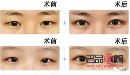 甲亢眼睛突出做手術(shù)要多少費(fèi)用(甲亢眼睛突出做手術(shù)要多少費(fèi)用呢)