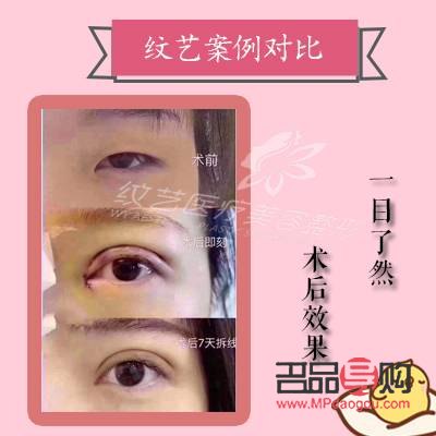 全切雙眼皮幾天恢復(全切雙眼皮幾天恢復正常)