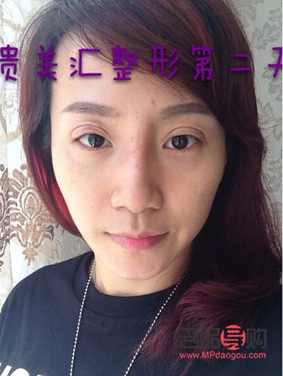 雙眼皮定位解析：了解雙眼皮美容手術的關鍵一步