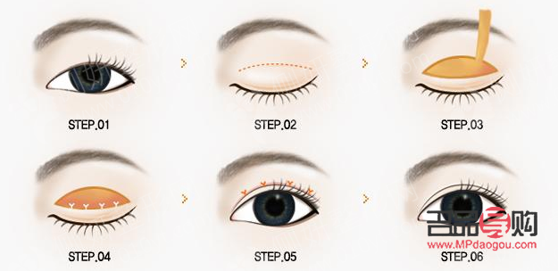 <h3>眼瞼重建術(shù)：重塑眼部輪廓，重拾自信之美</h3>