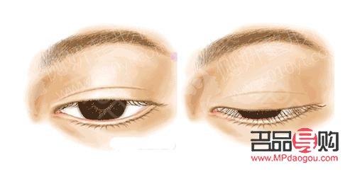 <h3>眼瞼重建術(shù)：重塑眼部輪廓，重拾自信之美</h3>