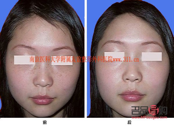 美容祛斑怎么(美容祛斑怎么做)