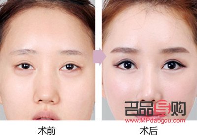 <h3>中國雙眼皮修復(fù)人：塑造美麗新傳奇</h3>