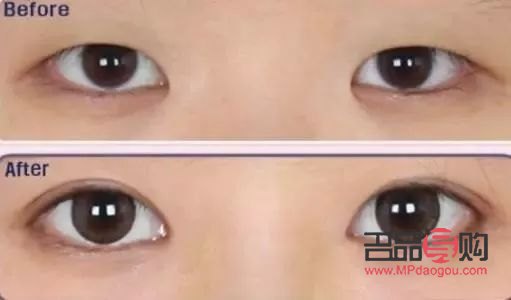 新月型雙眼皮：魅力之眼的新選擇