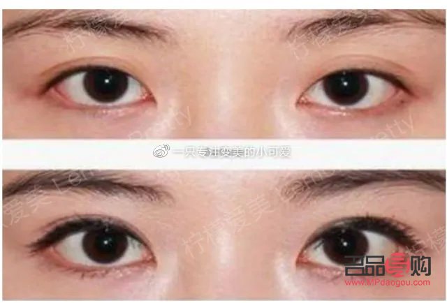 新月型雙眼皮：魅力之眼的新選擇