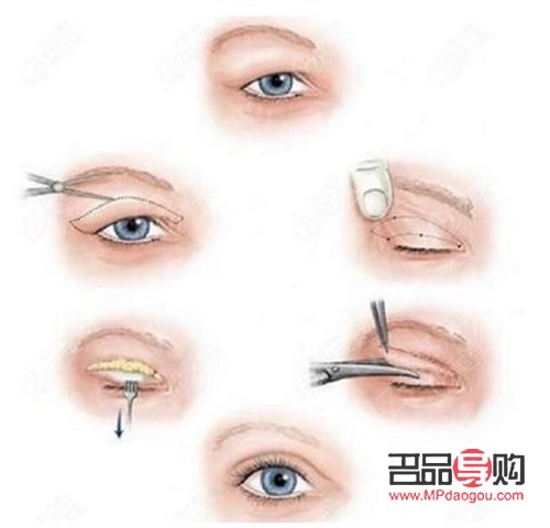 <h3>雙眼皮手術(shù)：現(xiàn)代流行的眼部美容新選擇</h3>