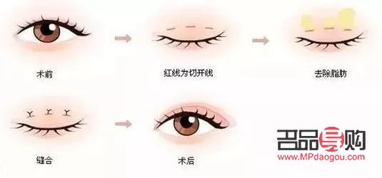 <h3>雙眼皮手術(shù)：現(xiàn)代流行的眼部美容新選擇</h3>