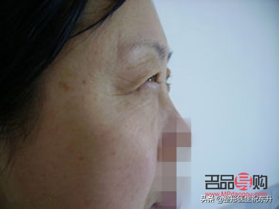 一單一雙眼皮怎么變成雙眼皮(一單一雙如何變成雙眼皮)