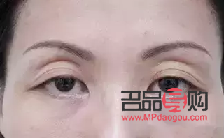 眼睛周圍凹陷怎么恢復(fù)飽滿圖片(眼睛周圍凹陷怎么恢復(fù)飽滿圖片女)