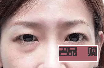 眼睛周圍凹陷怎么恢復(fù)飽滿圖片(眼睛周圍凹陷怎么恢復(fù)飽滿圖片女)