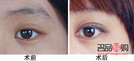 開(kāi)眼角手術(shù)費(fèi)多少(開(kāi)眼角手術(shù)費(fèi)多少錢一次)