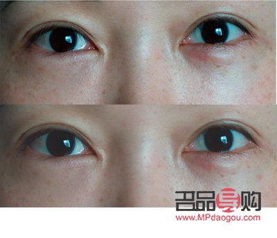 <h3>眼睛手術(shù)恢復(fù)正常的時(shí)長(zhǎng)探究</h3>