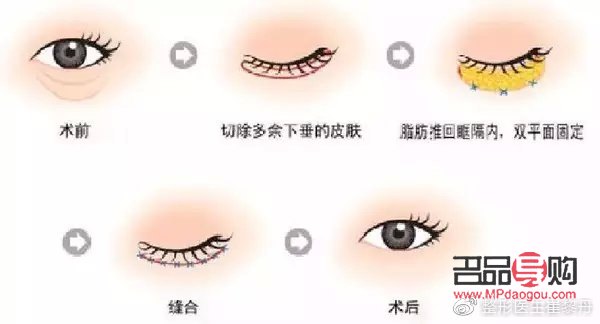 <h3>眼睛手術(shù)恢復(fù)正常的時(shí)長(zhǎng)探究</h3>