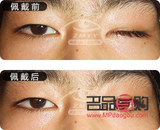 重慶義眼定做有哪些(重慶義眼定做有哪些地方)