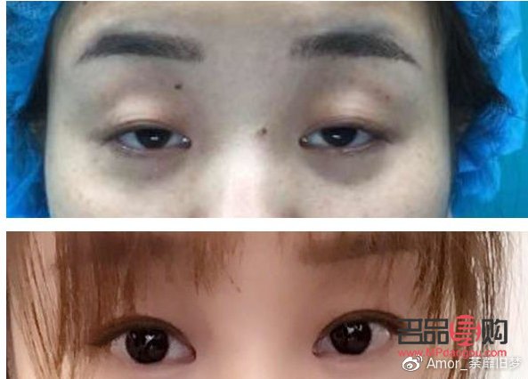 割雙眼皮提肌與不提肌的區(qū)別(眼睛提肌有必要做嗎)