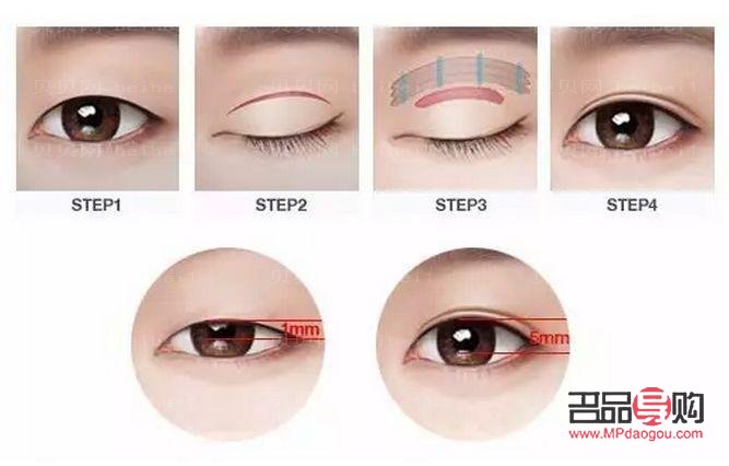 <h3>已有雙眼皮是否還能進(jìn)行埋線手術(shù)？</h3>