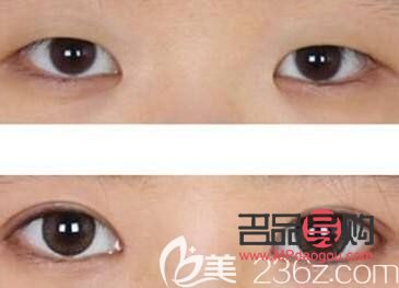 扇形雙眼皮顯老嗎(扇形雙眼皮顯老嗎圖片)