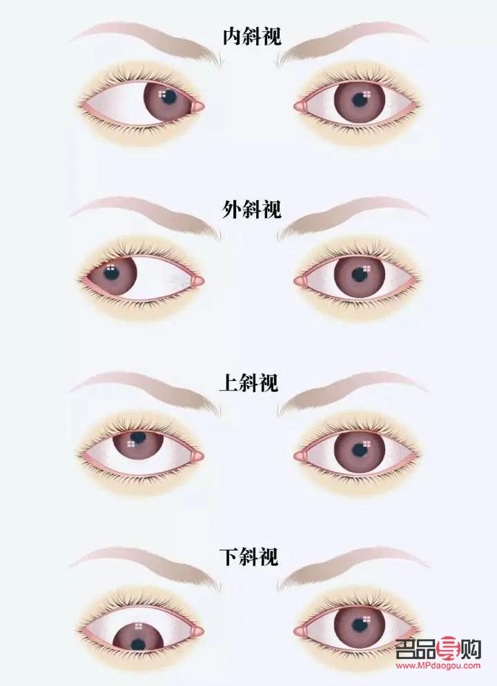 <h3>天生大小眼問題解析：女生是否能進(jìn)行矯正？</h3>