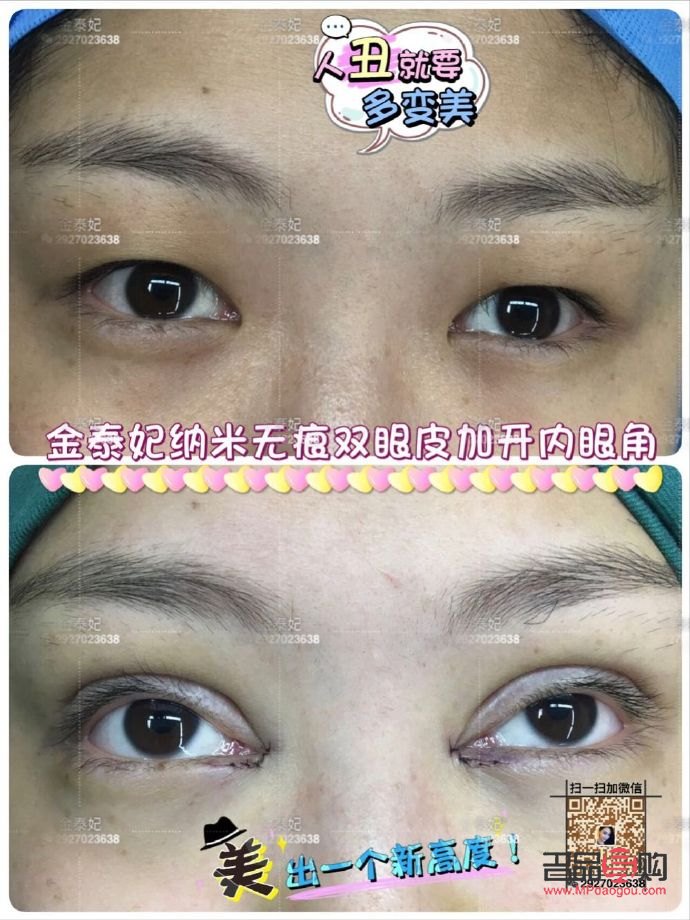 翹睫雙眼皮恢復(fù)全記錄：真實(shí)經(jīng)歷與心路歷程