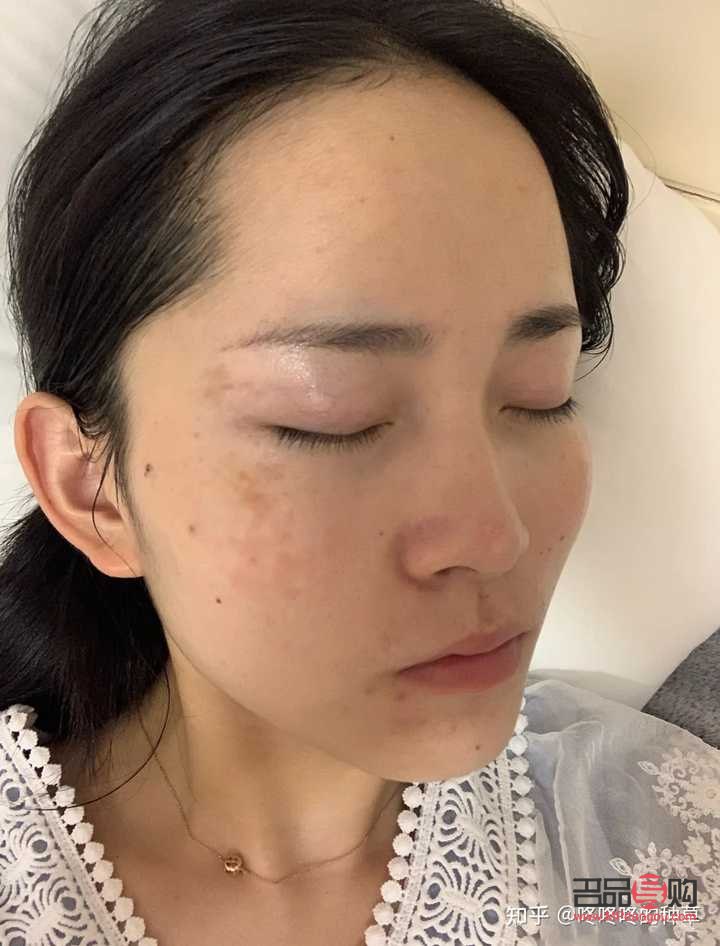 美容院祛雀斑效果好嗎？專業(yè)分析與建議