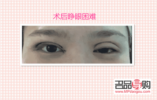 雙眼皮手術(shù)會(huì)有后遺癥嗎(雙眼皮手術(shù)會(huì)有后遺癥嗎?)