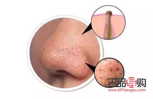 <h1>美容秘訣：如何高效去除黑頭</h1>