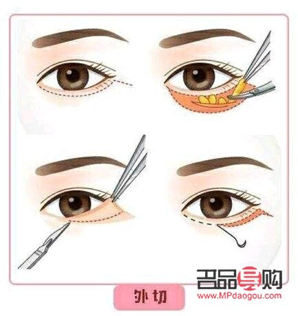 <h3>眼袋手術(shù)內(nèi)切與外切：選擇哪個更合適？</h3>