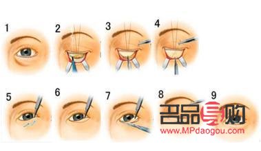 <h3>眼袋手術(shù)內(nèi)切與外切：選擇哪個更合適？</h3>