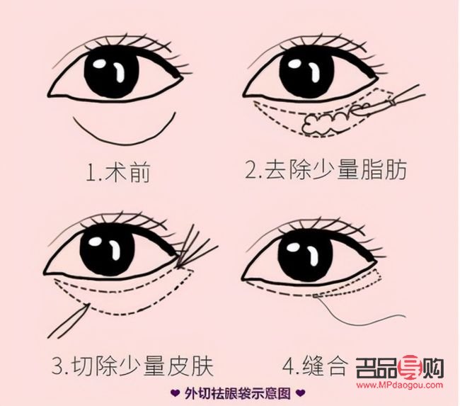 眼袋手術(shù)內(nèi)切與外切：選擇哪個(gè)更合適？