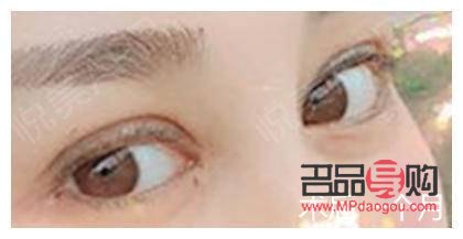 什么季節(jié)做雙眼皮好恢復(什么季節(jié)做雙眼皮好恢復快)