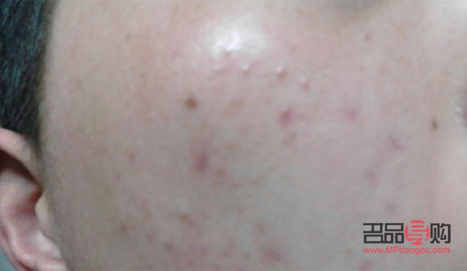 眼周圍扁平疣圖片(眼周圍扁平疣圖片大全)