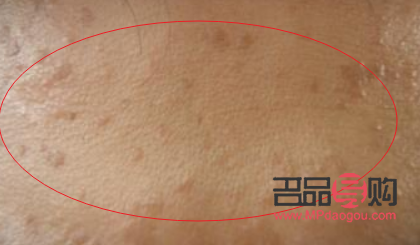 眼周圍扁平疣圖片(眼周圍扁平疣圖片大全)