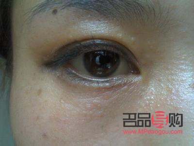 眼周圍扁平疣圖片(眼周圍扁平疣圖片大全)