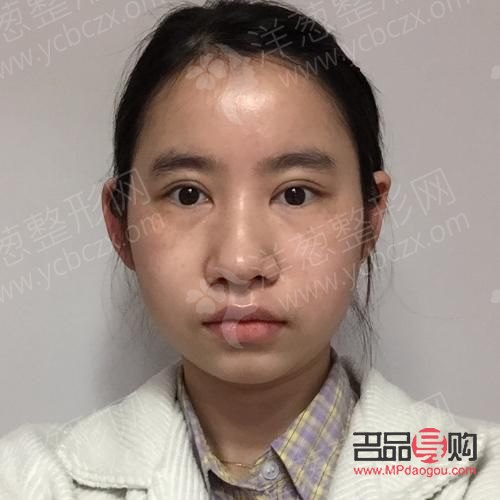 <h3>矯正眼睛一高一低，重塑自信面容</h3>