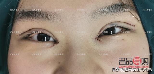 做了大綜合雙眼皮大概多久恢復(fù)好(做大綜合雙眼皮幾天能恢復(fù))