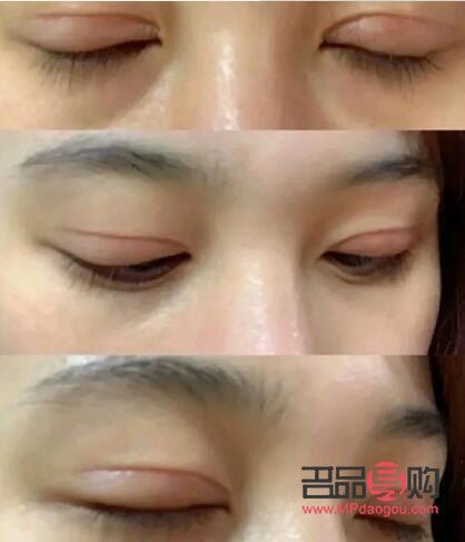 做了大綜合雙眼皮大概多久恢復(fù)好(做大綜合雙眼皮幾天能恢復(fù))