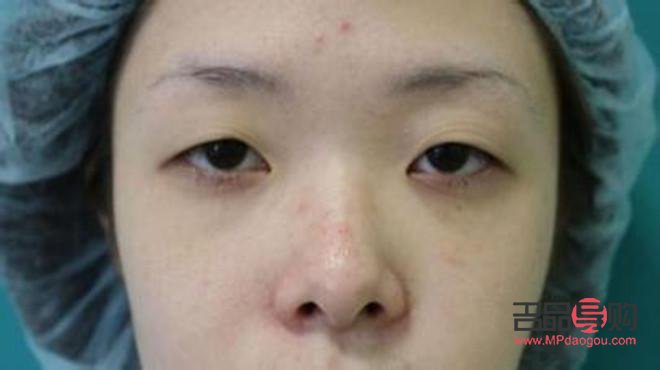 上眼皮松弛下垂做怎么改善(上眼皮松弛下垂做什么最有效)